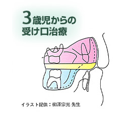 3歳児からの受け口治療